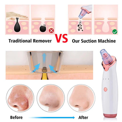 5-in-1 Blackhead remover | Rechargeable